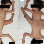 இந்தோனேசியாவில் பிறந்த சிலந்தி இரட்டையர்கள்